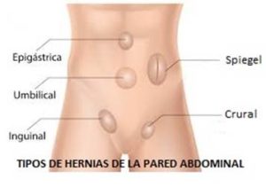 Además de la hernia inguinal