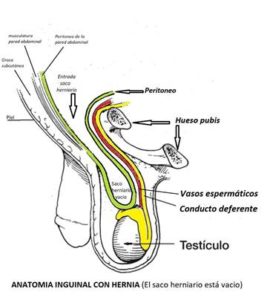 anillo inguinal 