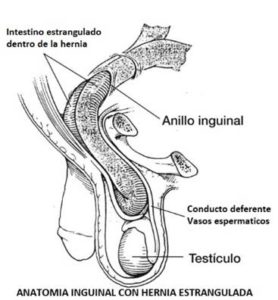 anillo inguinal 