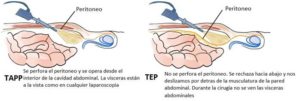 EVOLUCIÓN DEL TRATAMIENTO DE LA HERNIA INGUINAL