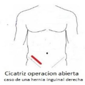 hernia inguinal por la vía abierta 