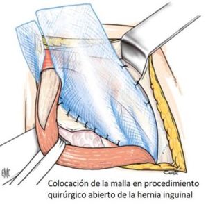 cirugía de la hernia inguinal