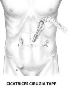 cirugía de la hernia inguinal